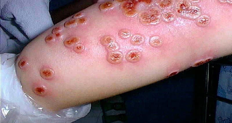 monkey pox