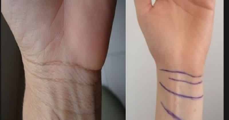 wrist line