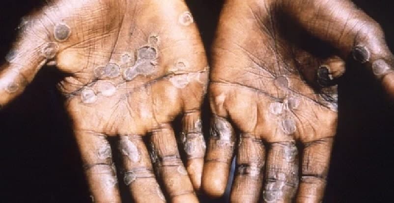 monkey pox